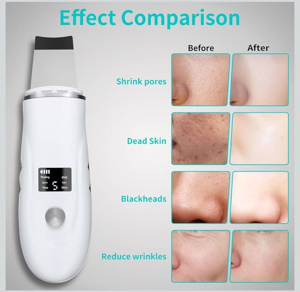 Ultrasonic Skin Scrubber 4-in-1 Deep Cleansing Tool for Pore Extraction